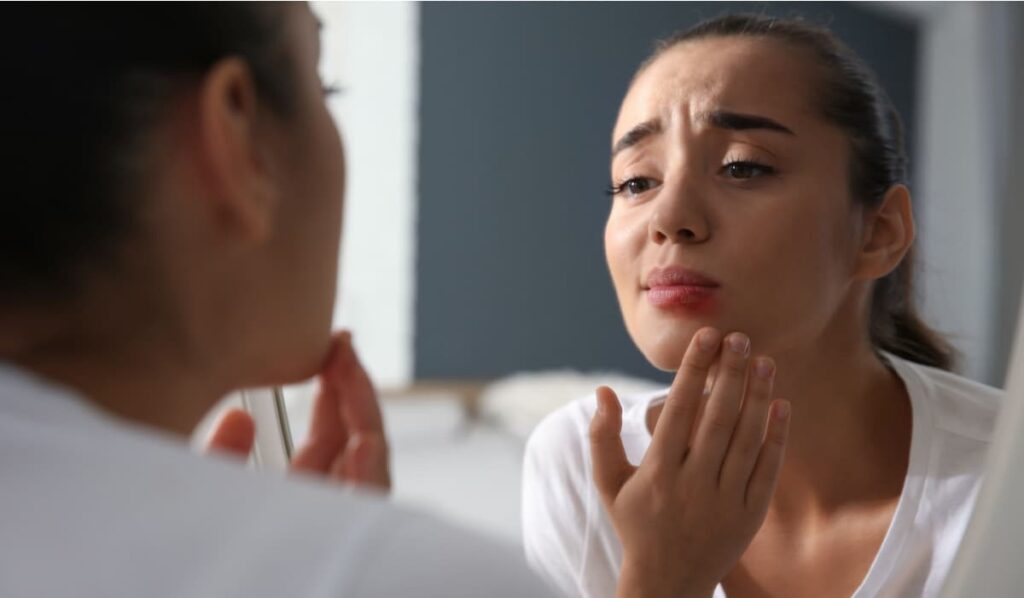 Herpes na usnama