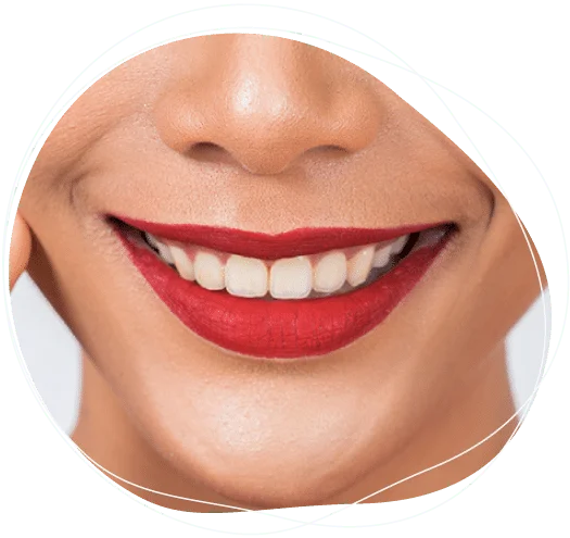 navlake za zube cena