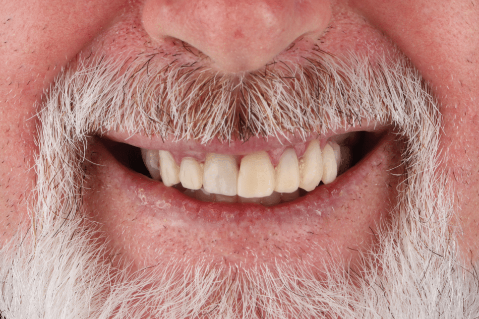 zubni implanti pre