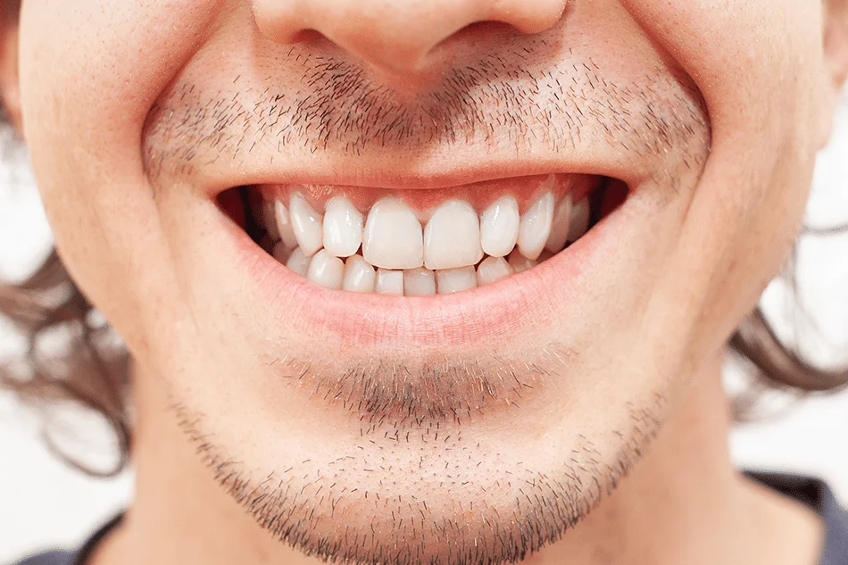 izbeljivanje-zuba-posle