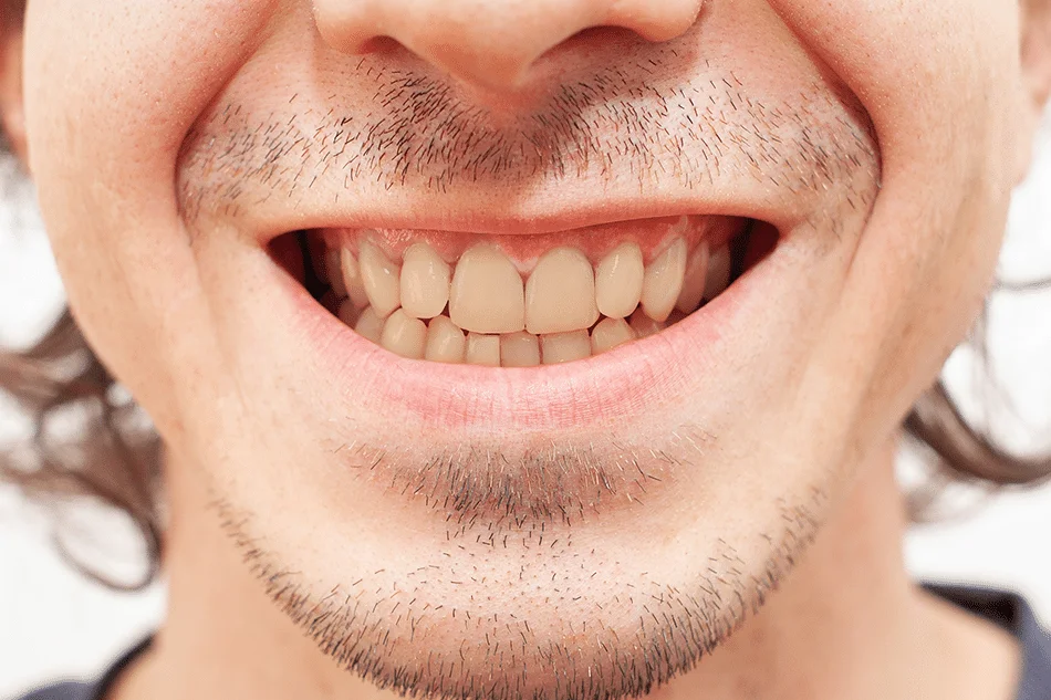 izbeljivanje-zuba-pre