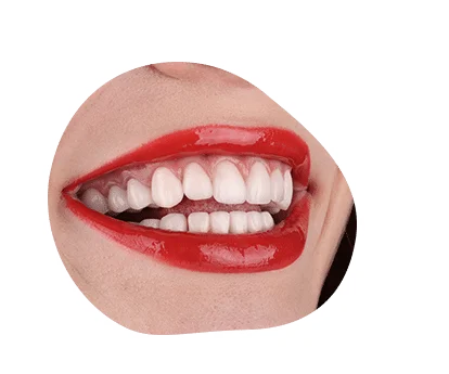 updent bezmetalne krune@414