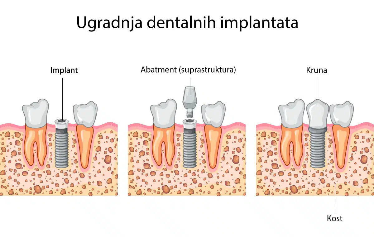 Ugradnja dentalnih implantata