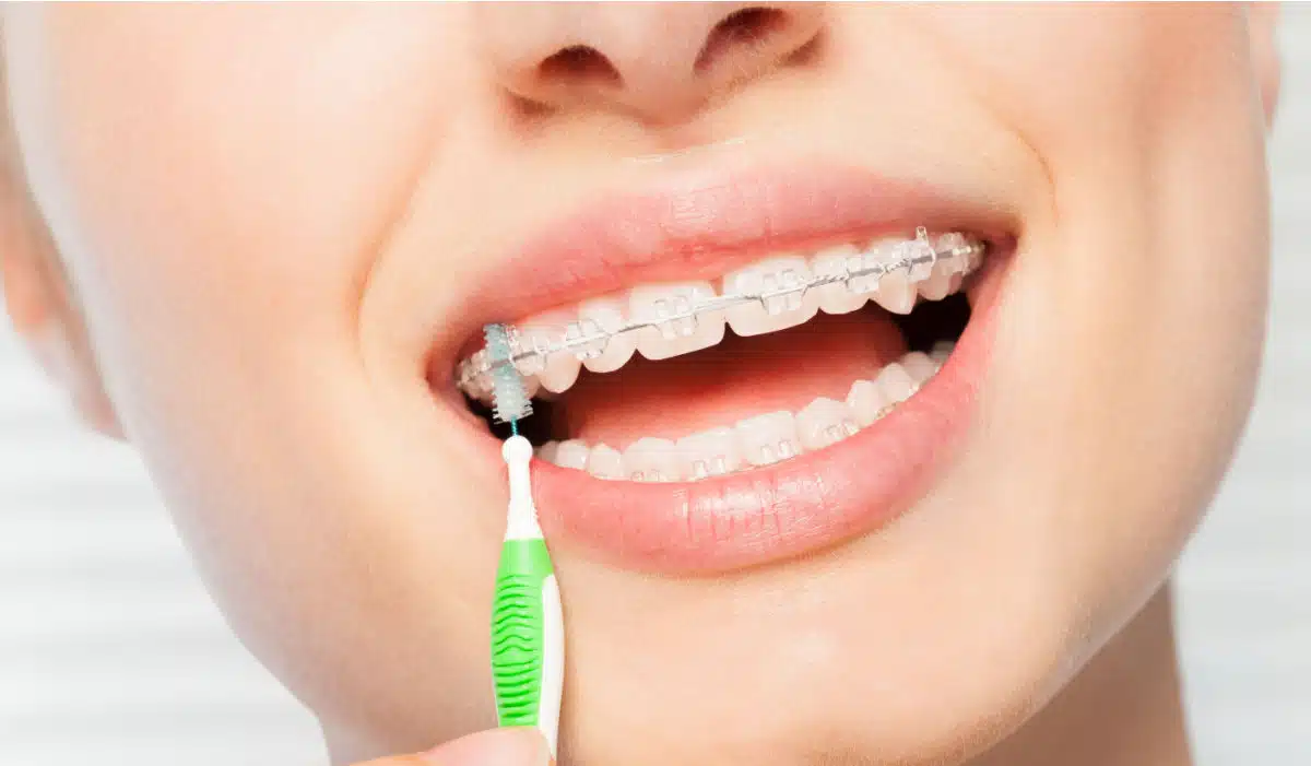 Kako održavati higijenu zuba sa fiksnom protezom