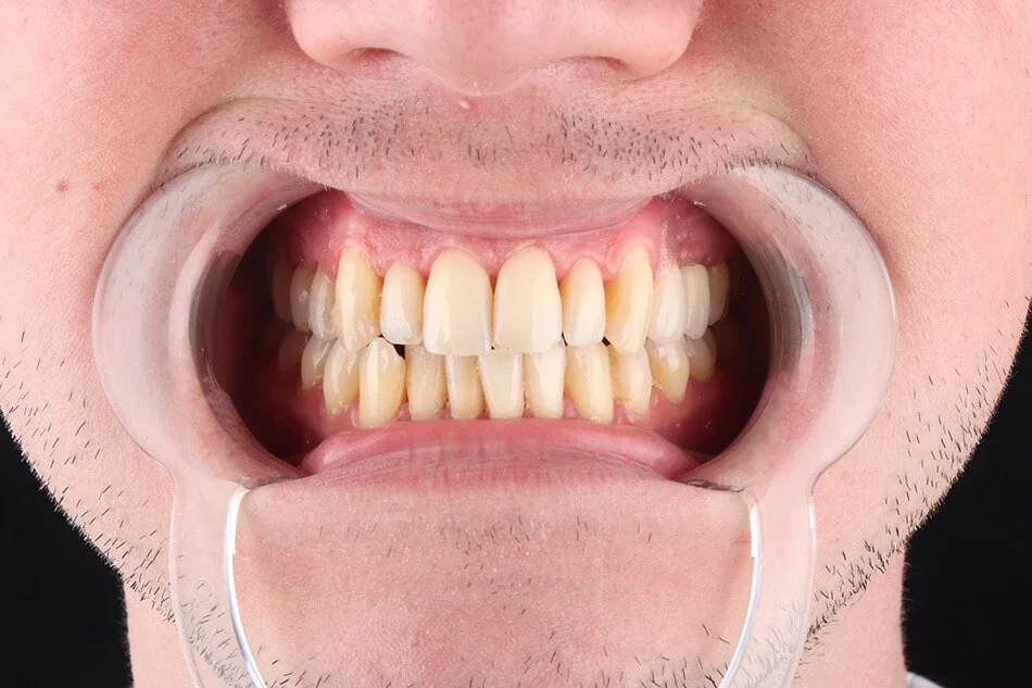 bruno-bezmetalne-pre