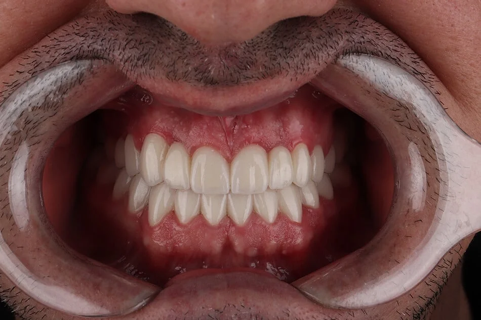 edi-bezmetalne-posle