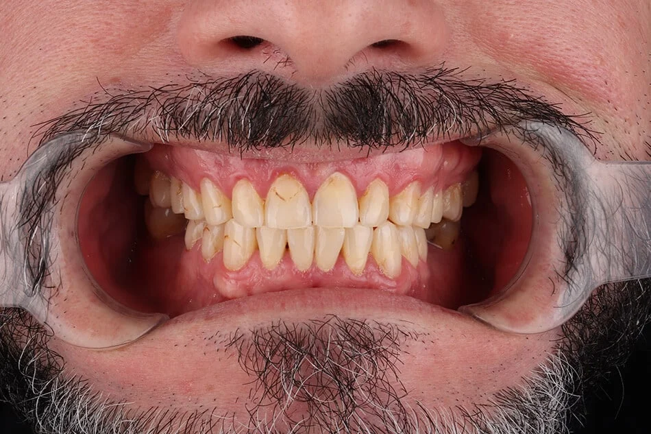 roman-bezmetalne-pre