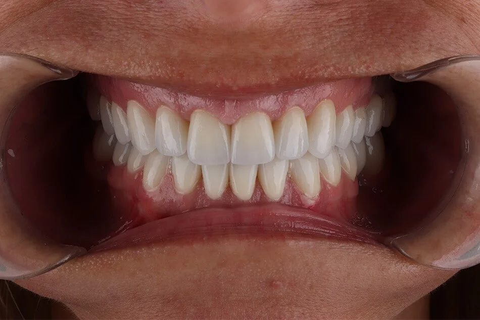 zorica-bezmetalne-posle