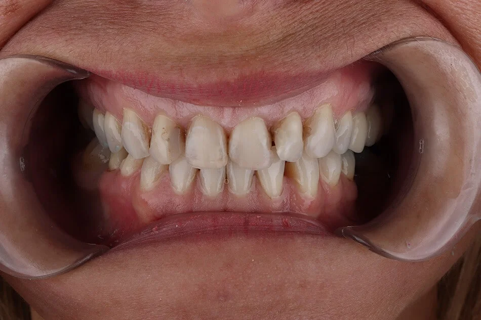 zorica-bezmetalne-pre