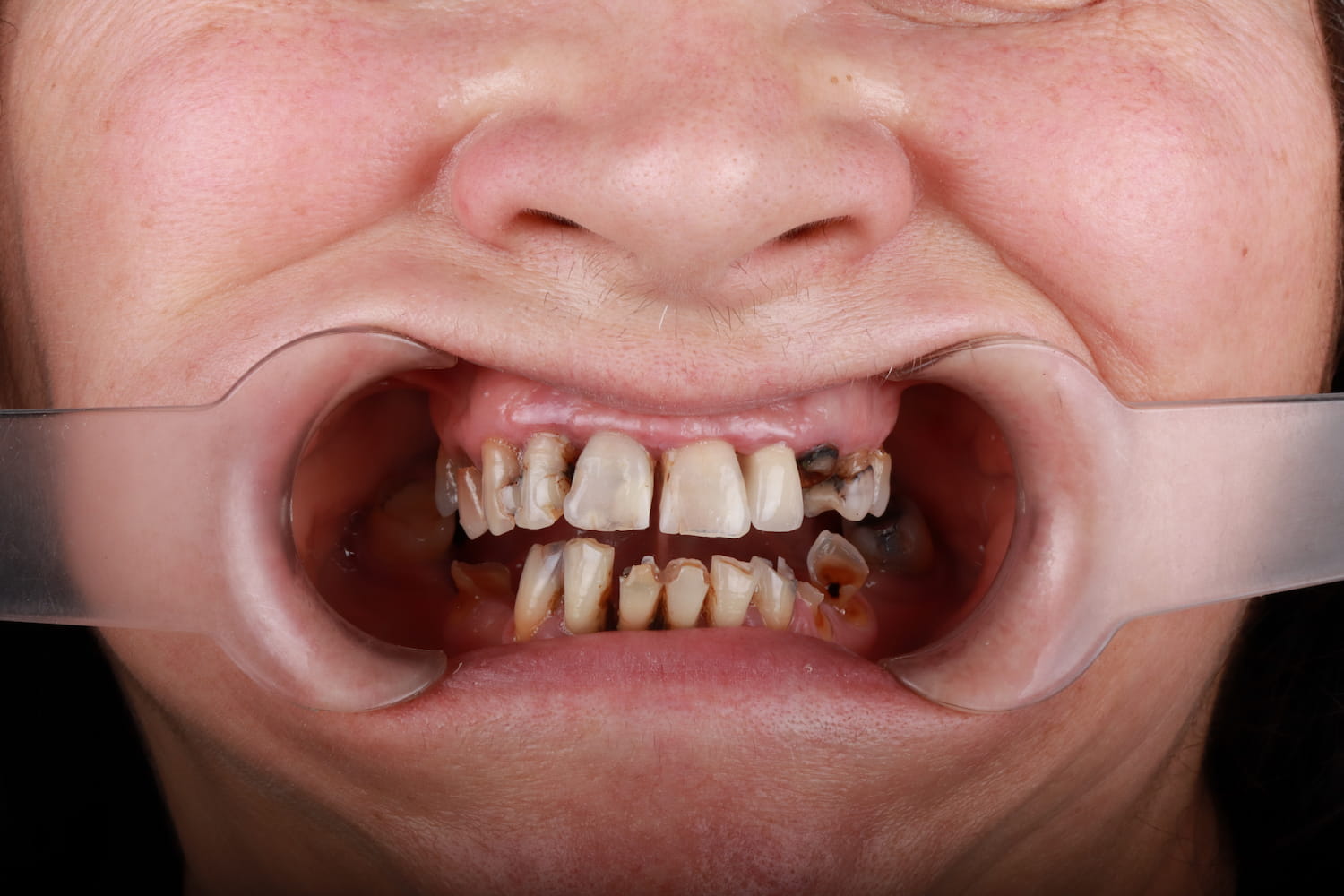 Slika pre ugradnje all on 4 implantata u ordinaciji Up Dent