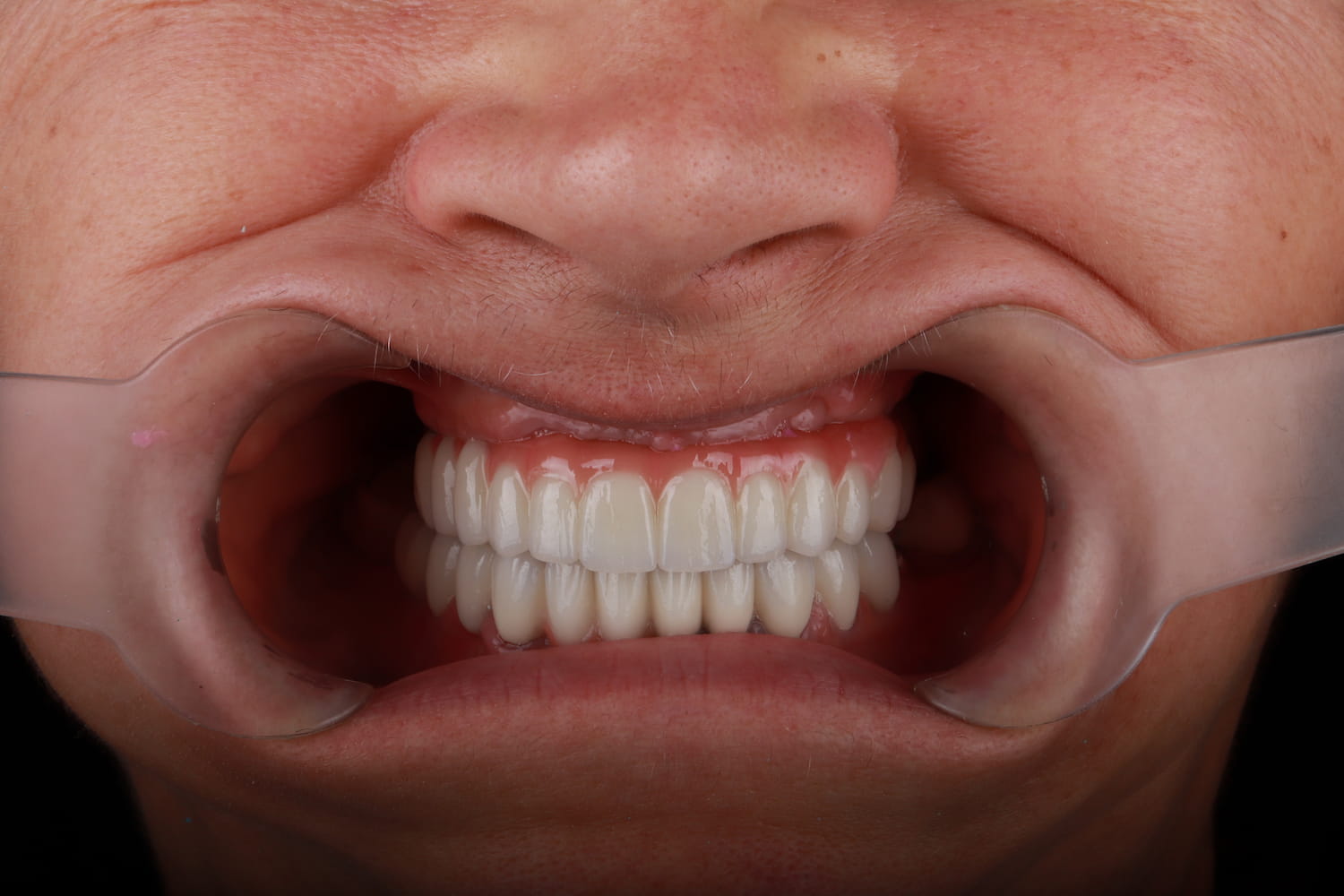 Slika nakon ugradnje all on 4 implantata u ordinaciji Up Dent